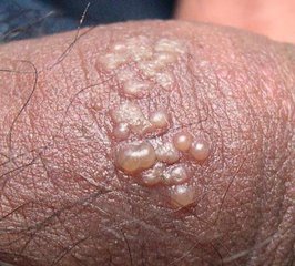 泡疹是什么引起的？疱疹对身体的危害有多大？