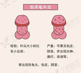 包皮红肿痒什么原因？【图】包皮红肿痒怎么办？