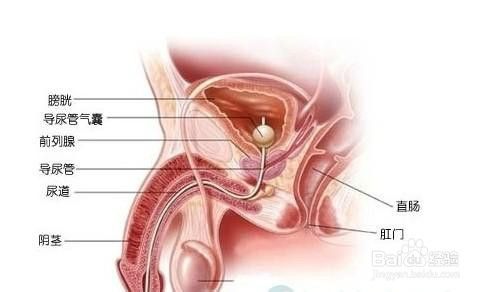 前列腺炎怎么手术治疗呢？手术后要注意什么？