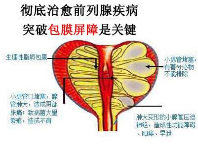 前列腺炎如何【切勿走进治疗误区】