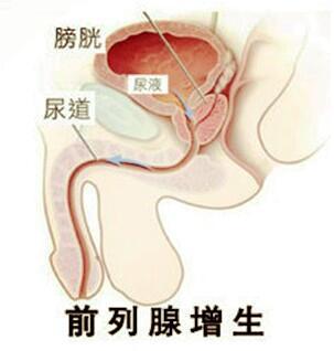 淮安治好前列腺增生要多少钱？淮安治疗前列腺增生的医院？