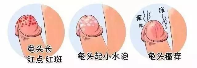 念珠菌如何治疗？【干货】不看后悔！