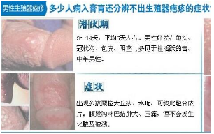 疱疹是怎么引起的【80的男性还认不出疱疹的症状】