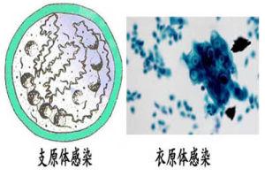 支原体衣原体感染症状【图解】这些症状要小心！