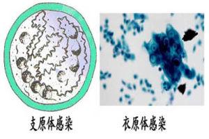 支原体衣原体感染症状【图解】这些症状要小心！