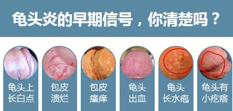 龟头炎症状用什么好?【症状表现以及常用】
