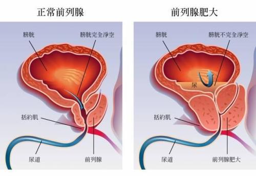 前列腺正常尺寸？前列腺生病，这些症状先出现