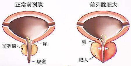 前列腺增大怎么办？三招帮您前“腺”减肥！